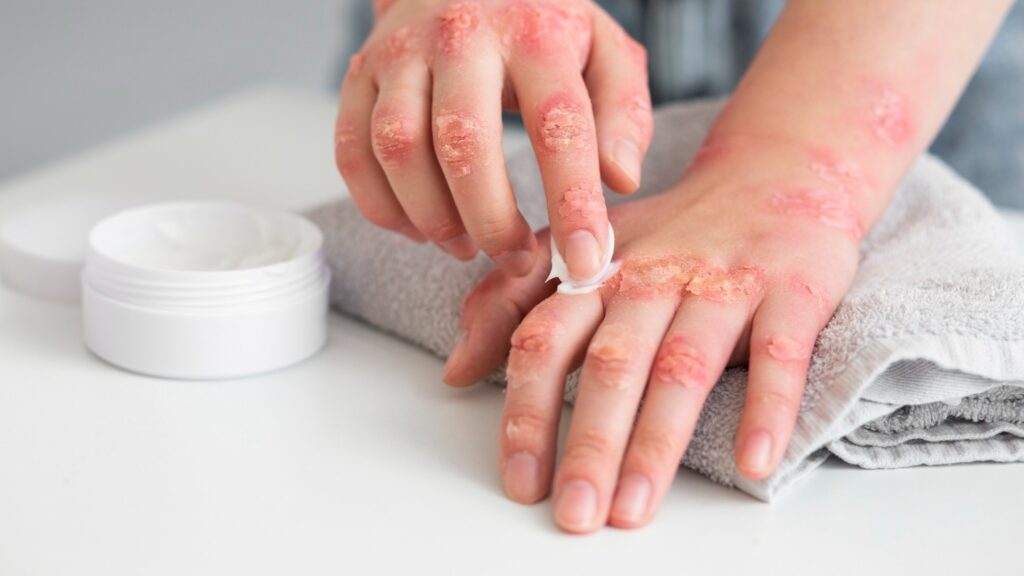 Psoriasis is veel meer dan enkel een huidziekte. Het is een chronische ontstekingsziekte die je hele lichaam beïnvloedt.